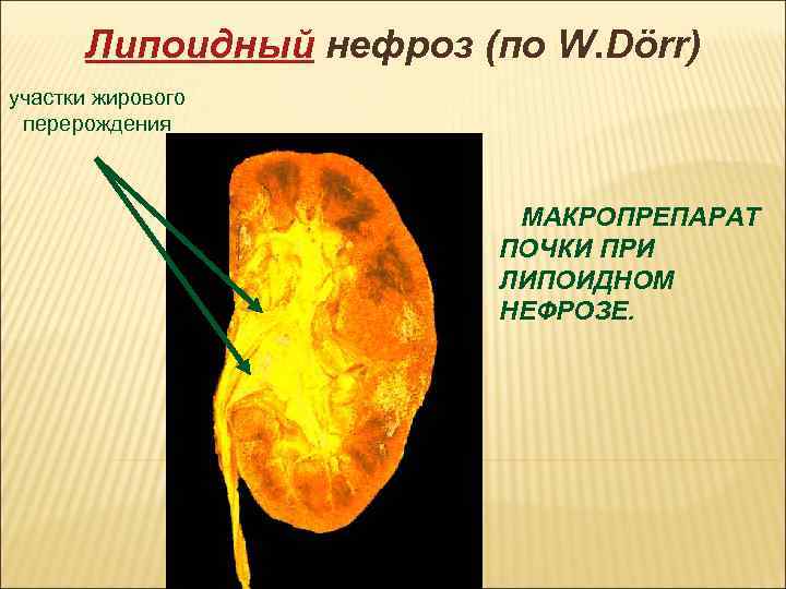 Нефроз. Амилоидно-липоидный нефроз патанатомия. Жировая дистрофия почек макропрепарат. Патанатомия нефрозы почек. Липоидный нефроз почки макропрепарат.