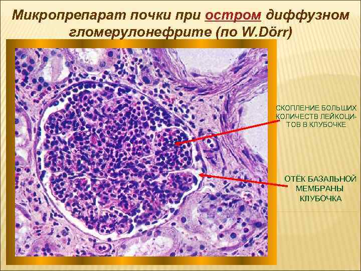 Микропрепарат почки при остром диффузном гломерулонефрите (по W. Dörr) СКОПЛЕНИЕ БОЛЬШИХ КОЛИЧЕСТВ ЛЕЙКОЦИТОВ В