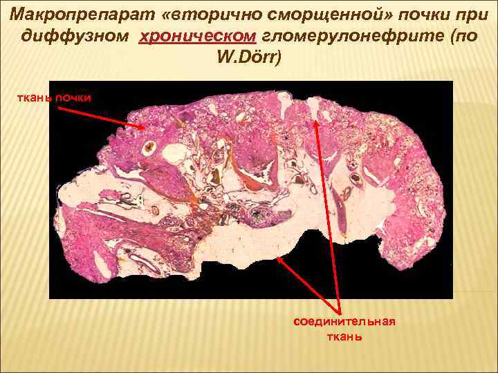 Макропрепарат «вторично сморщенной» почки при диффузном хроническом гломерулонефрите (по W. Dörr) ткань почки соединительная