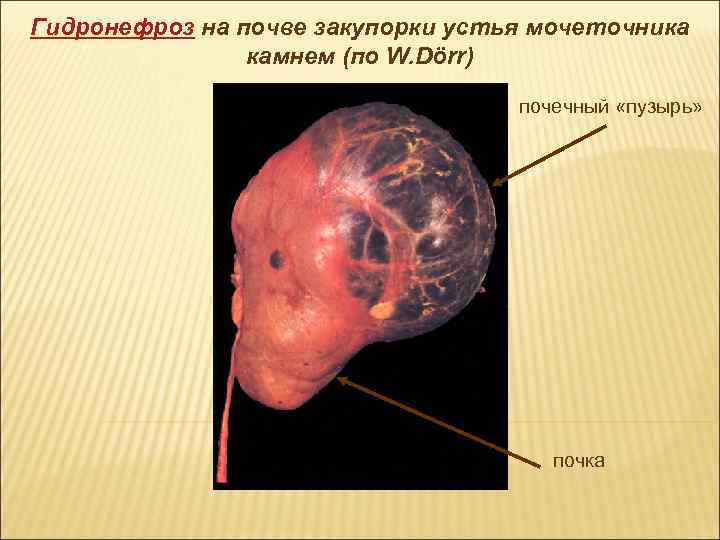 Гидронефроз на почве закупорки устья мочеточника камнем (по W. Dörr) почечный «пузырь» почка 