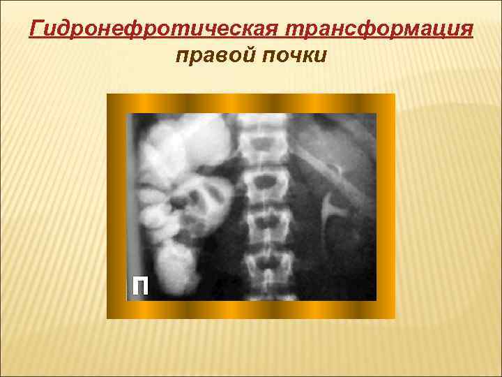 Гидронефротическая трансформация правой почки 