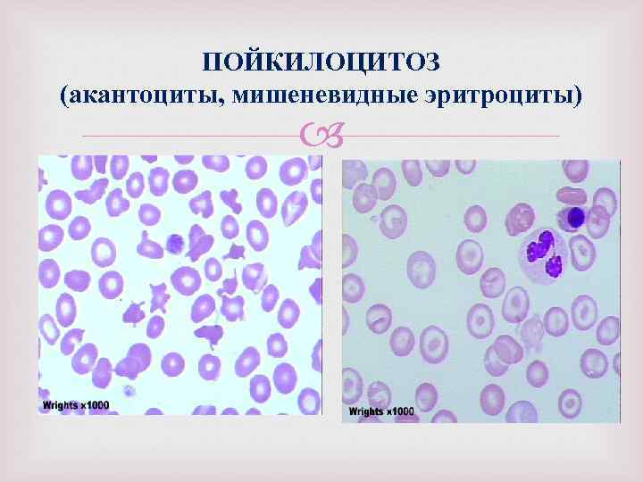 ПОЙКИЛОЦИТОЗ (акантоциты, мишеневидные эритроциты) 