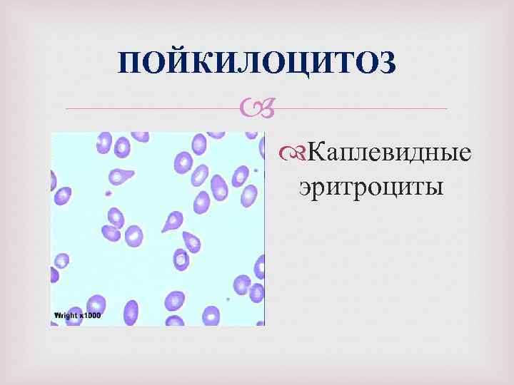 ПОЙКИЛОЦИТОЗ Каплевидные эритроциты 