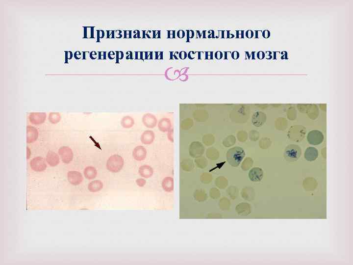 Признаки нормального регенерации костного мозга 