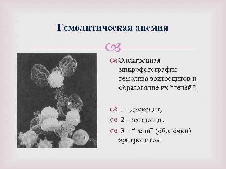 Гемолитическая анемия Электронная микрофотография гемолиза эритроцитов и образование их “теней”; 1 – дискоцит, 2