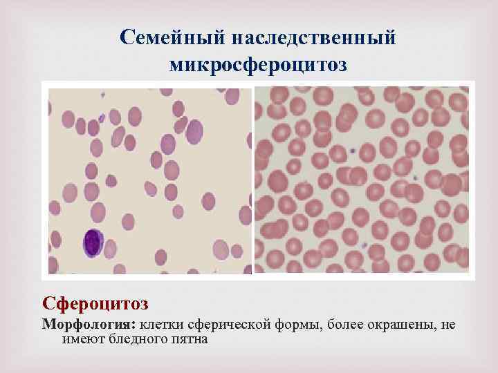 Микросфероцитоз