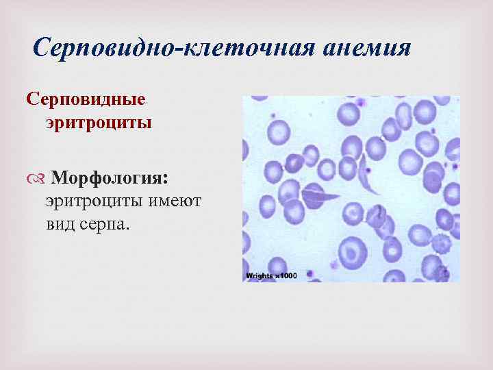 Серповидно-клеточная анемия Серповидные эритроциты Морфология: эритроциты имеют вид серпа. 