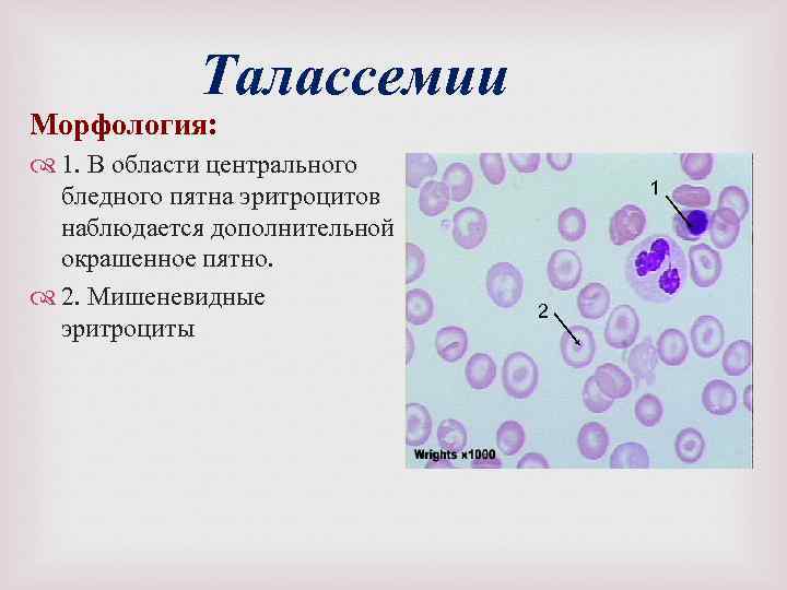 Талассемии Морфология: 1. В области центрального бледного пятна эритроцитов наблюдается дополнительной окрашенное пятно. 2.