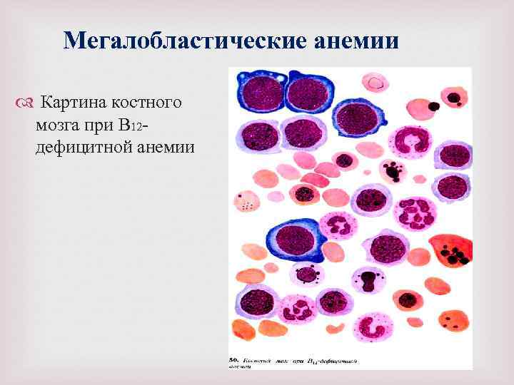 Мегалобластические анемии Картина костного мозга при В 12 дефицитной анемии 