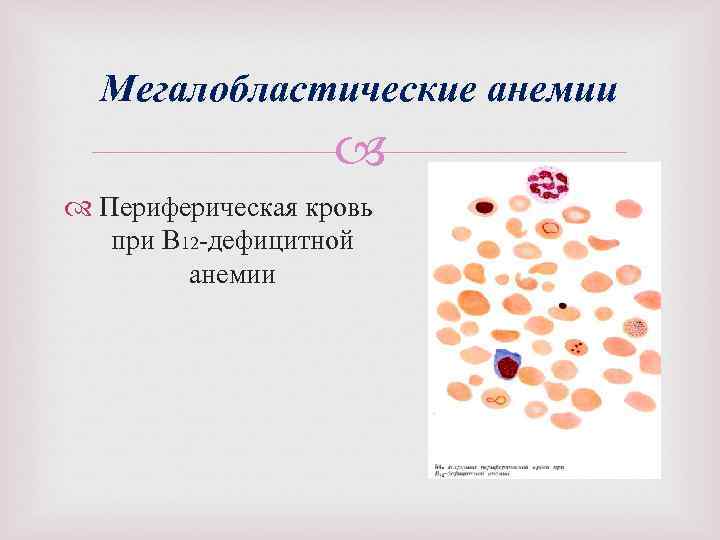 Картина крови при в12 дефицитной анемии периферической