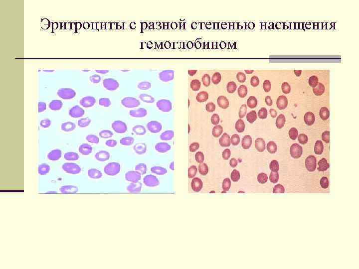 Морфологические изменения в эритроцитах рисунок