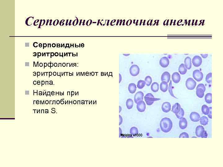 Эритроциты при серповидно клеточной анемии. Серповидноклеточная анемия гистология. Серповидноклеточная анемия эритроциты. Серповидноклеточная анемия показатели крови. Серповидноклеточная анемия частота встречаемости.