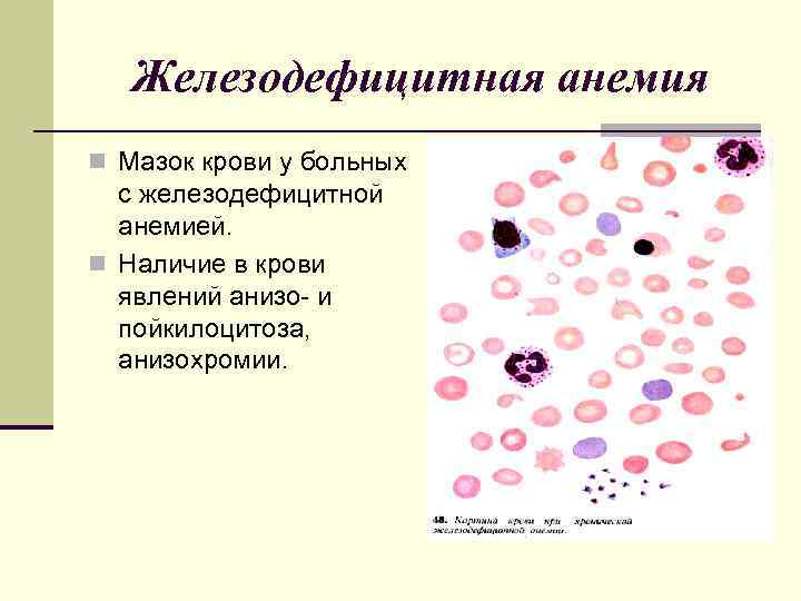 Железодефицитная анемия n Мазок крови у больных с железодефицитной анемией. n Наличие в крови