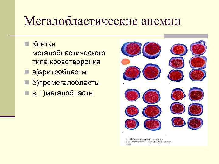 Мегалобластная анемия клиническая картина - 96 фото