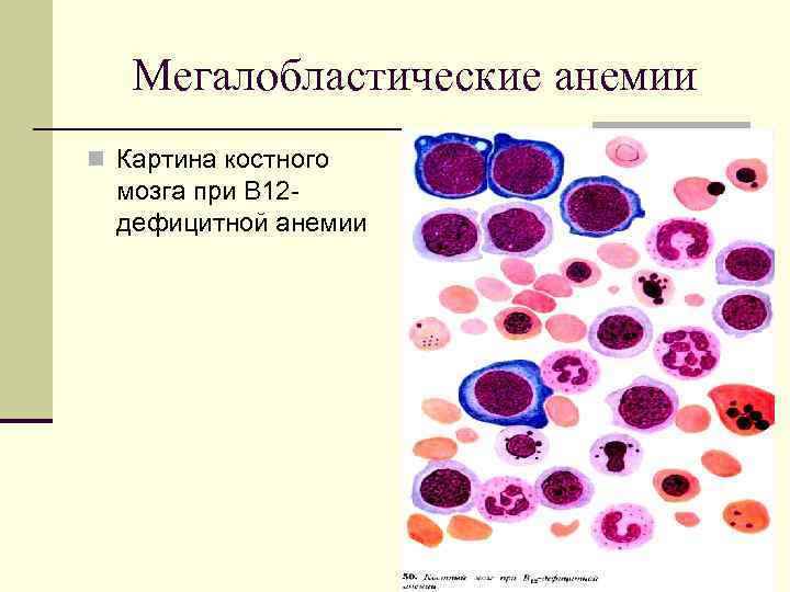 Мегалобластная анемия презентация