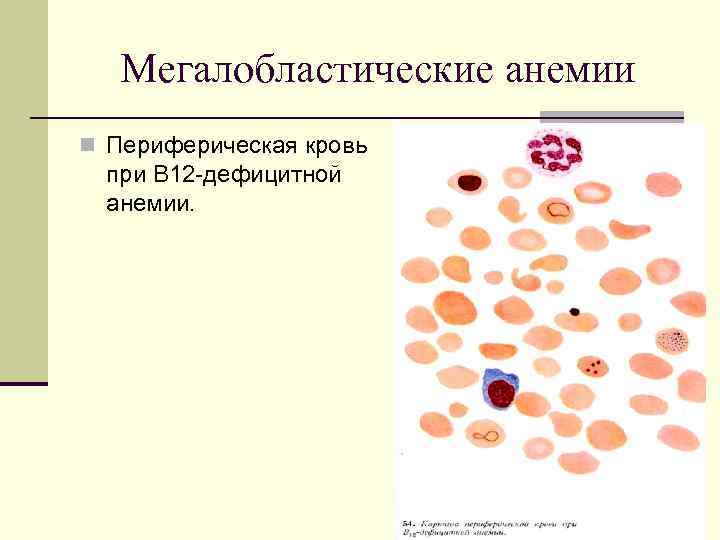 Картины анемии. Картина периферической крови при в12 дефицитной анемии. Мазок крови при в12 дефицитной анемии картина крови. В12 дефицитная анемия мегалобластная. Анализ крови при анемии в12 дефицитной анемии.