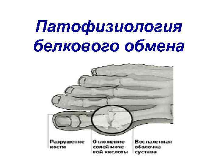 Патофизиология белкового обмена презентация