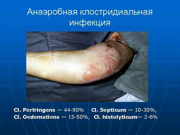 Анаэробная клостридиальная инфекция Сl. Perfringens — 44 -90% Cl. Septicum — 10 -30%, Сl.