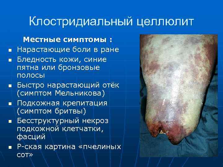 Клостридиальный целлюлит n n n Местные симптомы : Нарастающие боли в ране Бледность кожи,