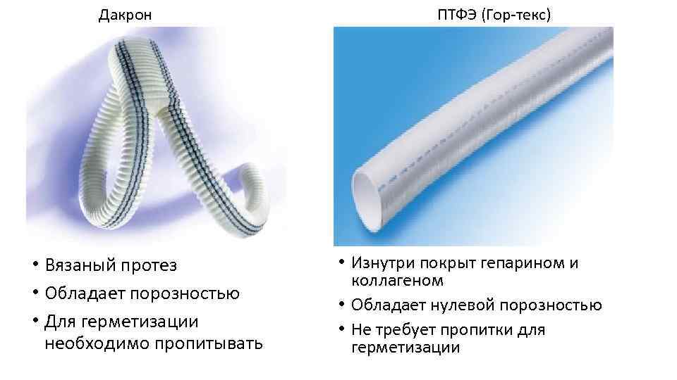 Дакрон • Вязаный протез • Обладает порозностью • Для герметизации необходимо пропитывать ПТФЭ (Гор-текс)