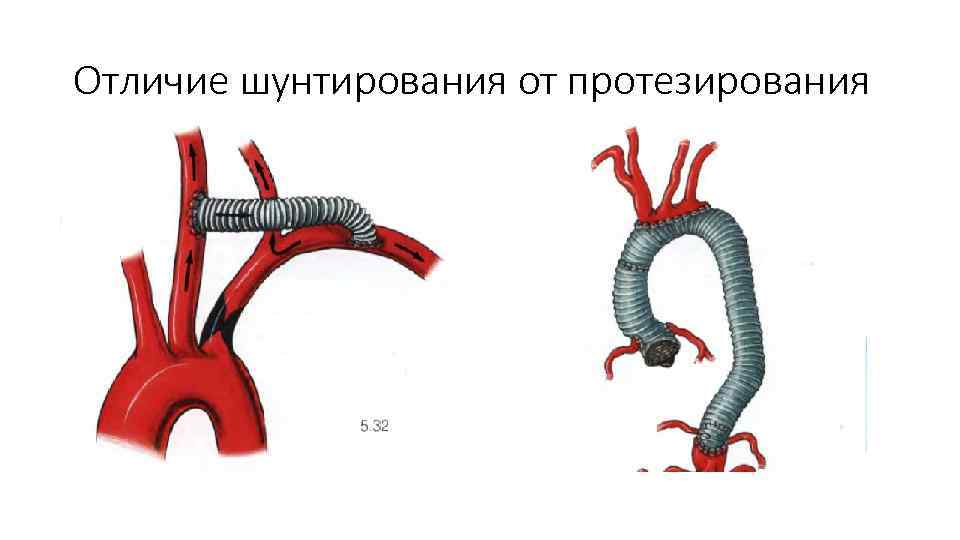 Отличие шунтирования от протезирования 