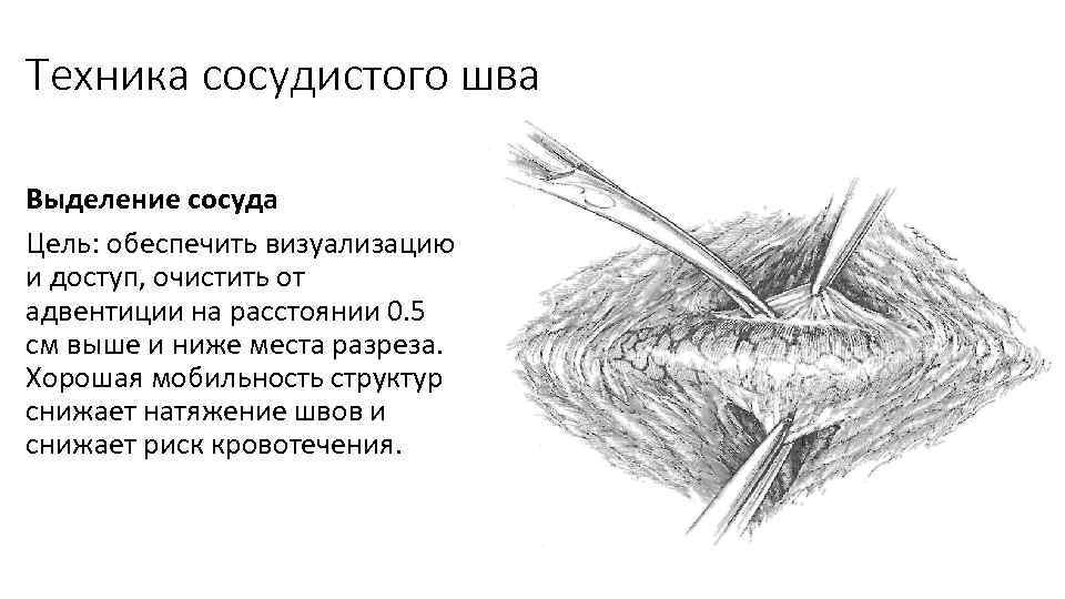 Сосудистый рисунок обеднен. Техника наложения сосудистого шва. Этапы наложения сосудистого шва. Принципы сосудистого шва. Рантовидный шов сосудистый.