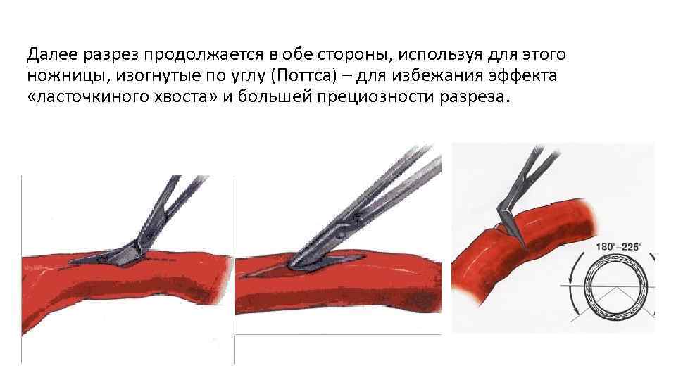 Слепой шов что это