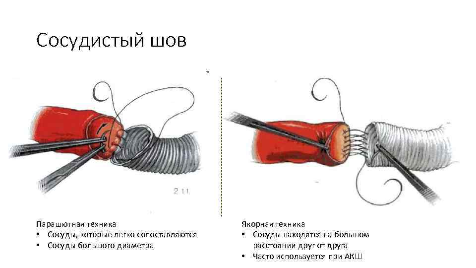 Сосудистый шов презентация