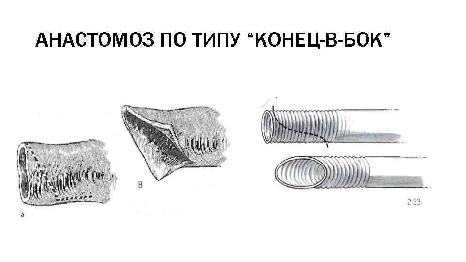 Анастомоз по брауну схема