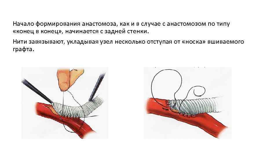 Анастомоз по брауну схема