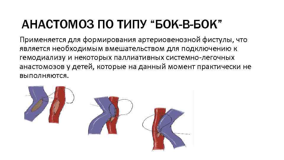 Сосудистый шов презентация