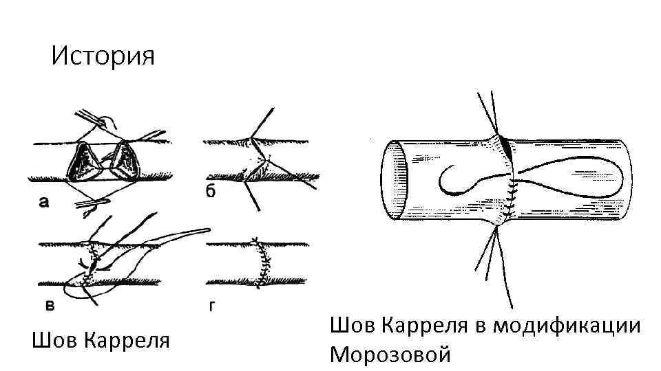 Сосудистый шов история