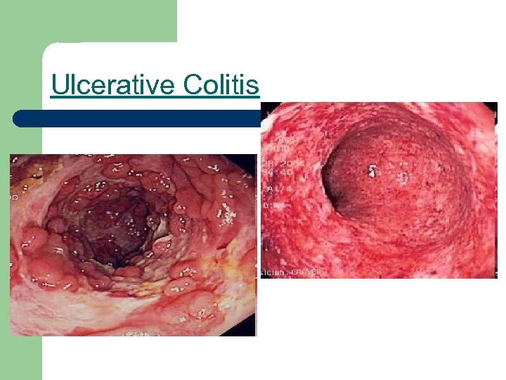 Ulcerative Colitis 