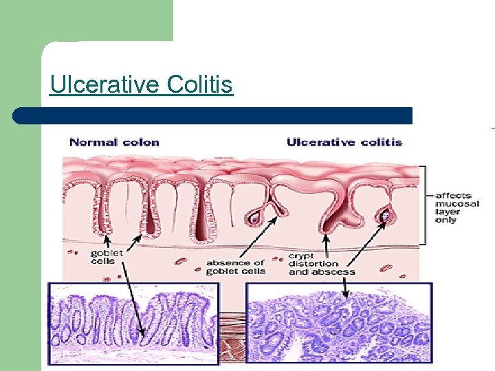 Ulcerative Colitis 