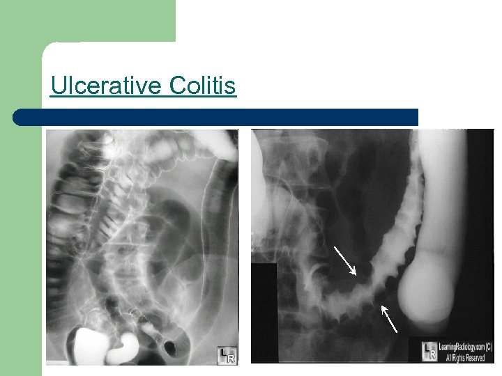 Ulcerative Colitis 