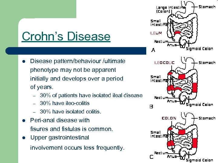 Crohn’s Disease l Disease pattern/behaviour /ultimate phenotype may not be apparent initially and develops