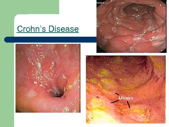 Crohn’s Disease 