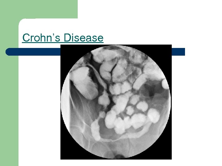 Crohn’s Disease 