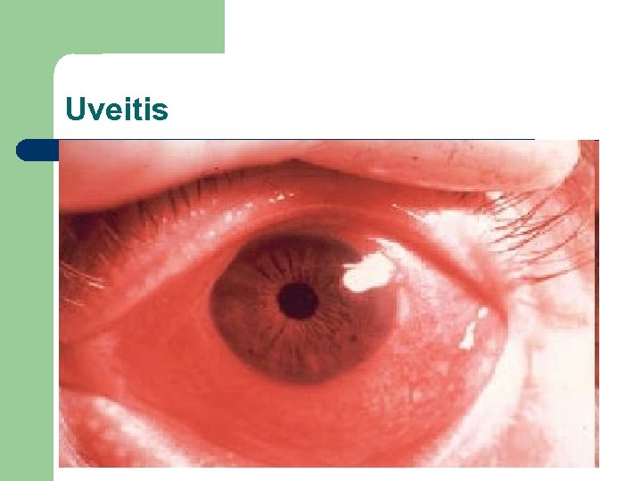 Uveitis 