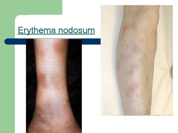 Erythema nodosum 