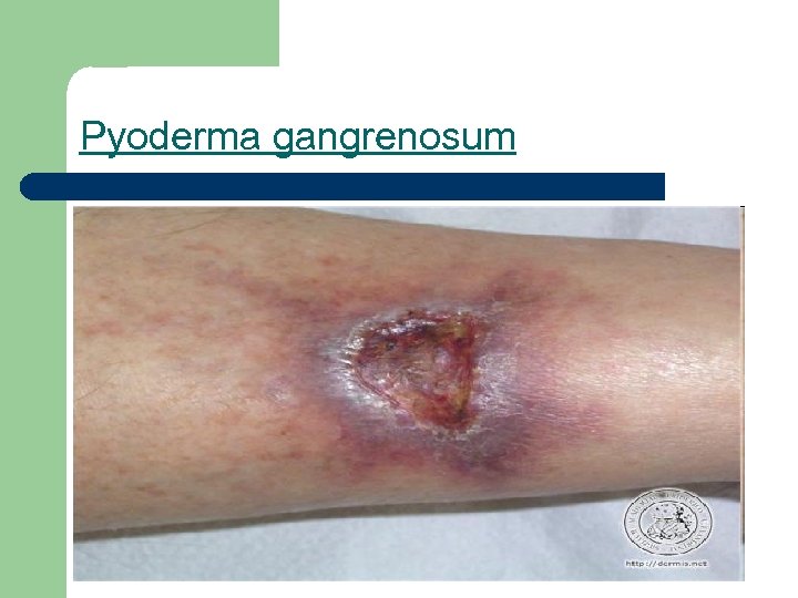 Pyoderma gangrenosum 