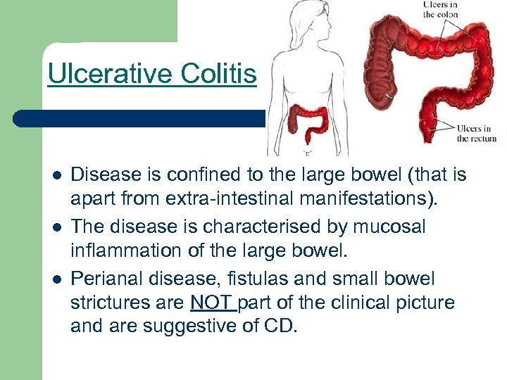 Ulcerative Colitis l l l Disease is confined to the large bowel (that is