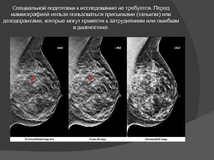 Специальной подготовки к исследованию не требуется. Перед маммографией нельзя пользоваться присыпками (тальком) или дезодорантами,