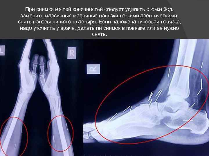При снимке костей конечностей следует удалить с кожи йод, заменить массивные масляные повязки легкими