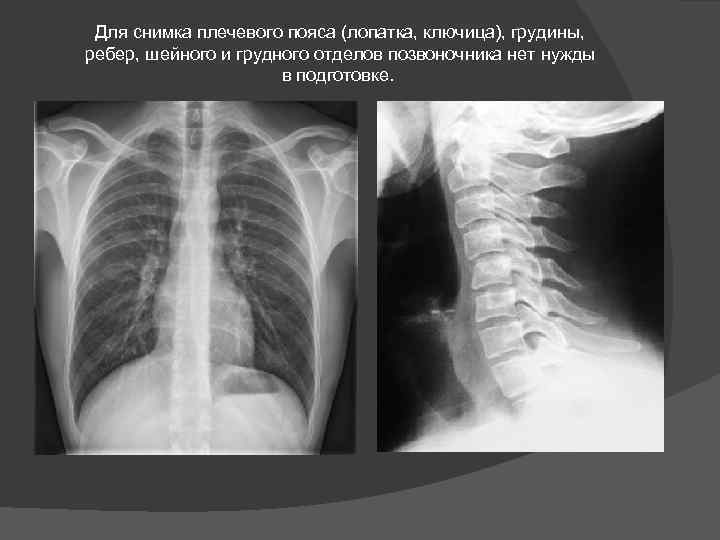 Для снимка плечевого пояса (лопатка, ключица), грудины, ребер, шейного и грудного отделов позвоночника нет