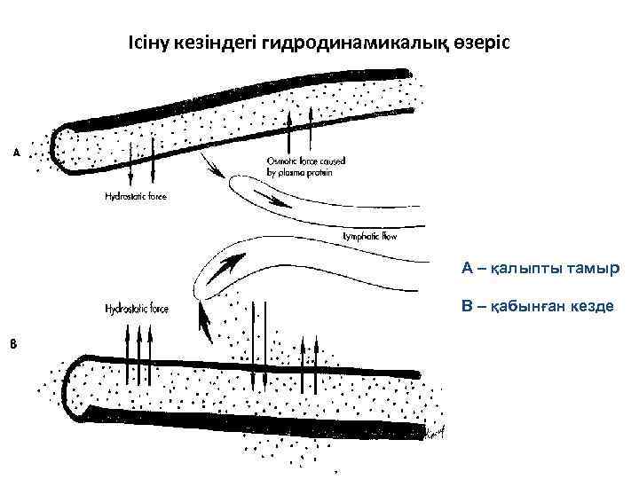 Ісіну кезіндегі гидродинамикалық өзеріс А – қалыпты тамыр В – қабынған кезде 