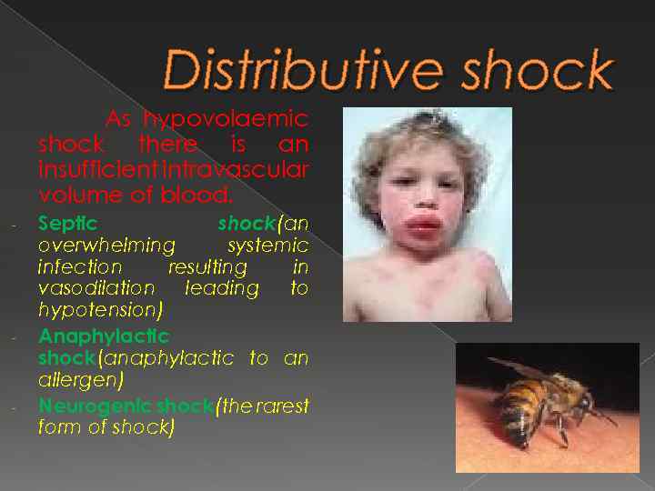 Distributive shock As hypovolaemic shock there is an insufficient intravascular volume of blood. -