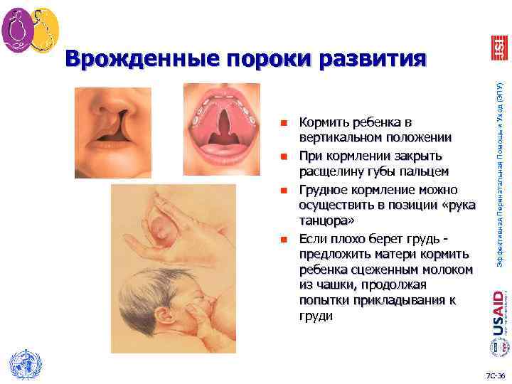 n n Кормить ребенка в вертикальном положении При кормлении закрыть расщелину губы пальцем Грудное