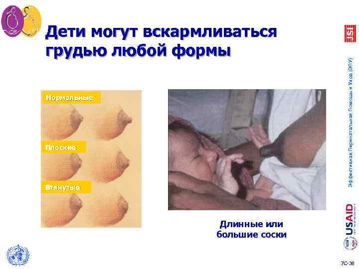 Нормальные Плоские Втянутые Эффективная Перинатальная Помощь и Уход (ЭПУ) Дети могут вскармливаться грудью любой