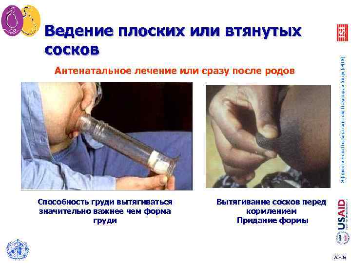 Антенатальное лечение или сразу после родов Способность груди вытягиваться значительно важнее чем форма груди